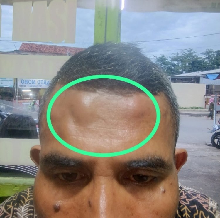 Lagi Lagi Wartawan Jadi Korban Pengeroyokan Diduga Akibat Penelusuran Miras Ilegal